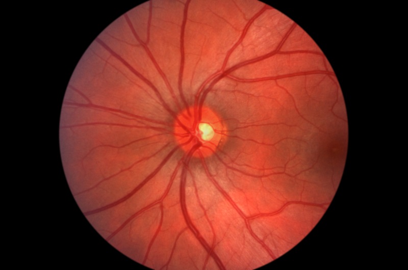 Glaucoma  Draper, UT 